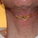 nightmare from lsl ... one month after surgery.