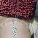 7 days post op