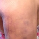 Some of the bruising
