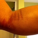 Most of the bruising is near the lower incision site, both sides look like this (I wonder if the compression garment has anything to do with this)
