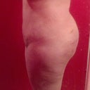 4 weeks post op