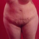 4 weeks post op