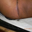 healing great..this incision is the same on both sides ..extended tummy tuck
