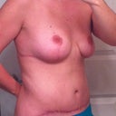 6 months post op - side view