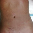 1 day post op on the table getting changed