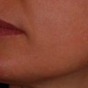 Photofacial Treatment For Rosacea