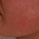 Photofacial Treatment For Rosacea