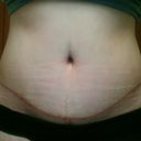 scar appears to be reder than it is, but still looking for a good scar treatment