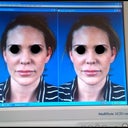 Before and after from computer morphing