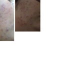 Now-2 months after the treatment
