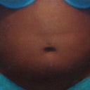 Stomach Day 4 post op