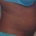 Side Day 4 post op
