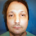 Rhinoplasty For Crooked Nose And Difficulty Breathing After Trauma To Nose