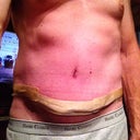 PO WEEK 2 using silicone scar strips for comfort.