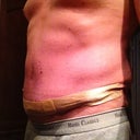 PO WEEK 2 using silicone scar strips for comfort.