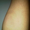 right inner thigh a few hours after treatment, swollen and faintly pink.