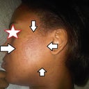 The next day after the treatment