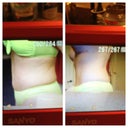 6 mos post op before touch up lipo and 9 mos post op after touch up and working out