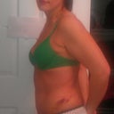 2 week Post OP
