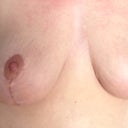 post op 1 month
