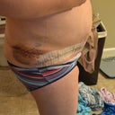 left 3 days post op