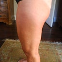 left lateral thigh 3 1/2 months later- LOOK HOW SMOOTH IT LOOKS!   Compare to the before - I had dimples and bumpiness everywhere!