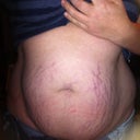 This is two YEARS after giving birth and my stretch marks suck!!!