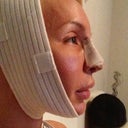 3rd night in, a bit of swelling but deprojection is already visible in my profile!