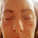 brown lines appeared after thread lift-Radiess aggravated temporarily..I am allergic toRadiessse-caused intenses swelling, redness for almost 2 weeks- had to take steroids to help resolve..