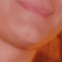 After. There is an UNAPPEALING, unnatural, STARK GAP. between Chin-Sides/Cheeks and Lower lip /Lip-Ends. Most chin volume removed. Face Rounded. Flattened.