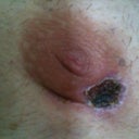 scabbed areola post infection