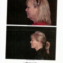 I had very loose jowls and neck skin. It is gone!