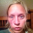 A few days after the surgery