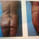 My back and butt before surgery