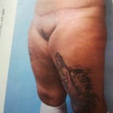 My thighs before surgery