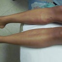 One day after surgery, this was at the doctors office during my first post op visit