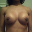 almost 6 weeks post op