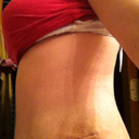 8 weeks post side view