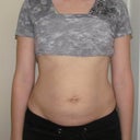 Relaxing my muscles, my stomach distends because of the separation.