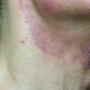 day 13 left red scar but heal afterwards