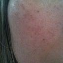 5 days after fraxel, right.