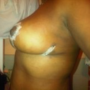 5 days post op