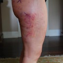right lateral thigh, 2 days post procedure