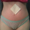 2 weeks post op