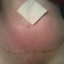 2 week post op incision healing nicely
