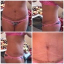 Incision area