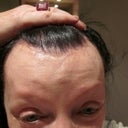 My Browlift has left it all LUMPY and horrible and veins