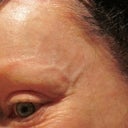 I now have veins showing on both left and right side from brow lift