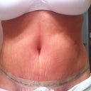 3 days post op.  I LOVE my new tummy, swelling and all!
