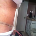3 days post op side view.  You can see I am still hunched over!